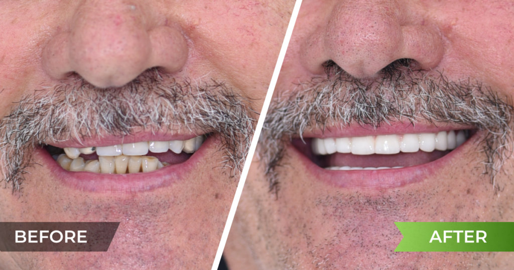 Full restoration of the upper and lower jaw in bruxism