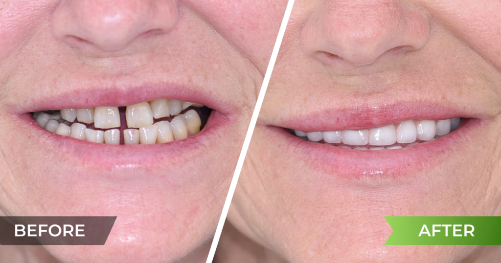 Full restoration of both jaws with implants and metal-ceramic crowns in bone loss and a reverse bite