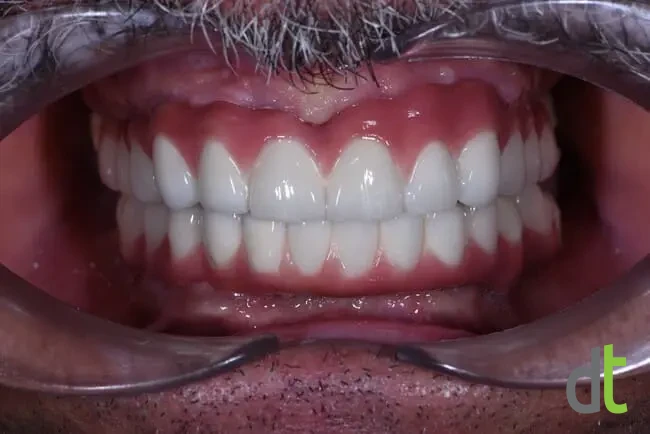 Intraoral condition after full restoration with fixed metal-ceramic restorations