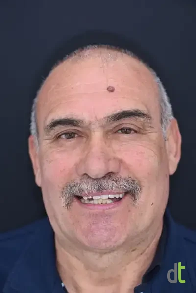 Face and smile before full restoration of the upper and lower jaw