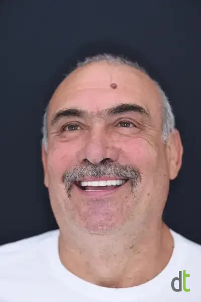 Face and smile after full restoration of the upper and lower jaw