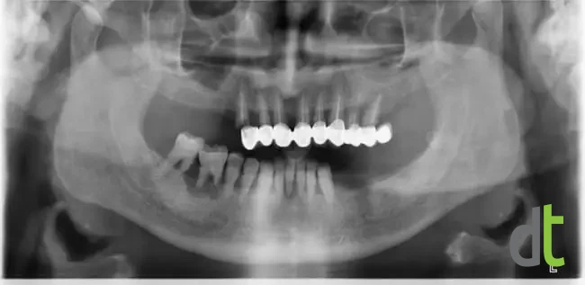 Panoramic radiograph before treatment, with missing posterior teeth and an existing restoration in the upper jaw