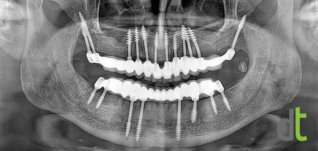 Panoramic radiograph after restoration of both jaws with basal implants and fixed restorations