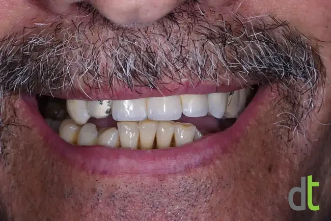 Smile before treatment, with a visibly failing restoration in the upper jaw