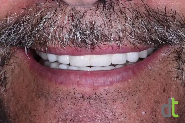 Smile after restoration of both jaws with fixed restorations on basal implants