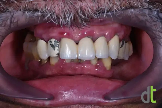 Initial intraoral condition with a failing upper restoration, missing teeth and periodontal problems