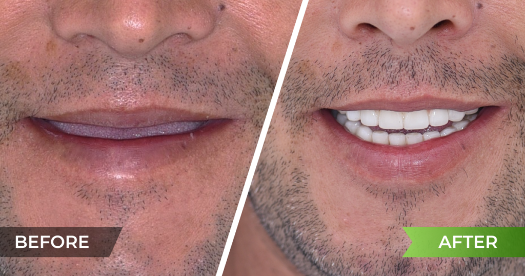 Full restoration of both jaws with implants when no teeth remain