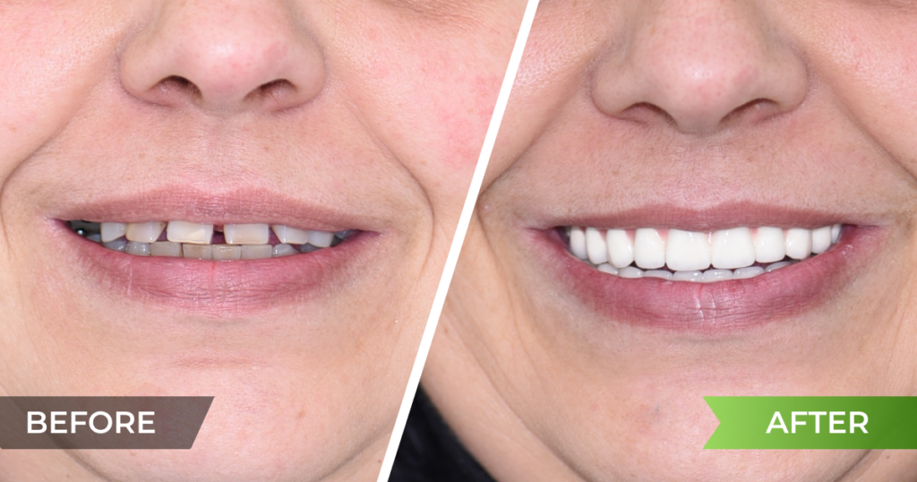 Complex treatment with implants in the upper jaw and a combined restoration on teeth and implants in the lower jaw