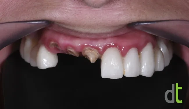 Upper jaw before treatment, with compromised restorations in the front