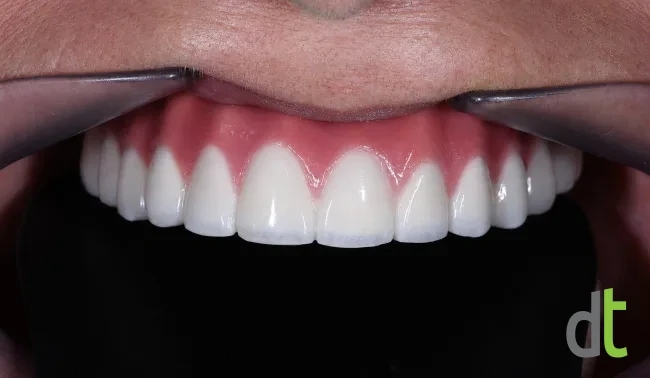 Upper jaw after treatment, with a fixed bridge on implants