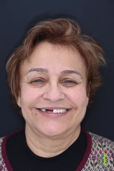 Face and smile before treatment of the upper jaw