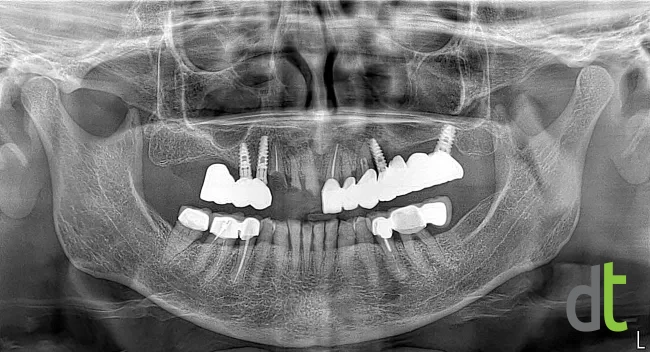 Panoramic radiograph before treatment, with existing old implants and restorations