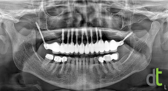 Panoramic radiograph after restoration of the upper jaw with corticobasal implants and a fixed bridge