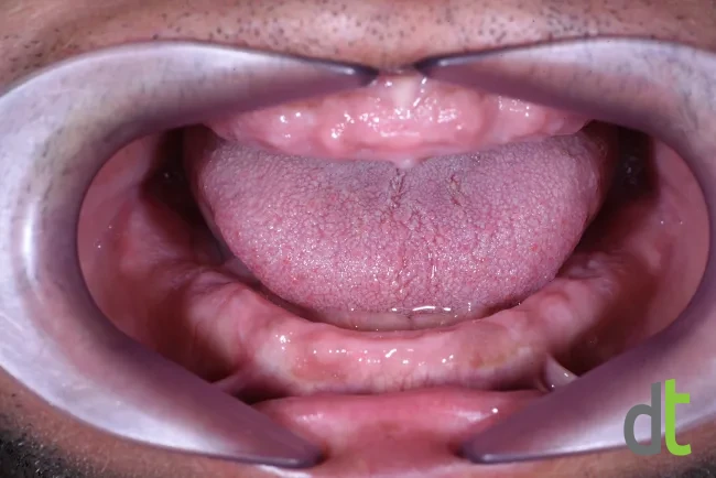 Initial intraoral condition with a fully edentulous upper and lower jaw