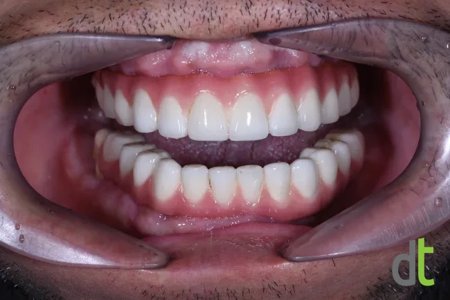 Fixed restorations on basal implants, with the mouth open, after treatment