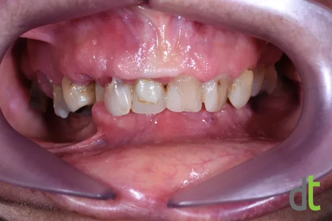 Initial condition with broken and missing teeth and a deep bite