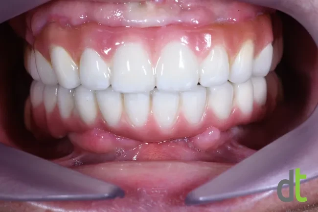 Fixed metal-ceramic restorations after restoration of the upper and lower jaw