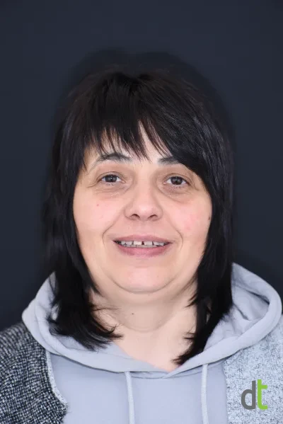 Portrait before the complex treatment