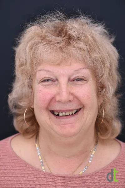 Face and smile before full restoration of both jaws