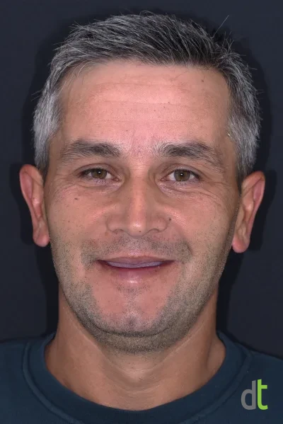 Face before treatment, with no teeth remaining