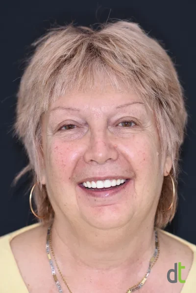 Face and smile after full restoration of both jaws with basal implants