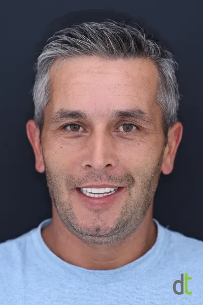 Face after full restoration of both jaws with basal implants