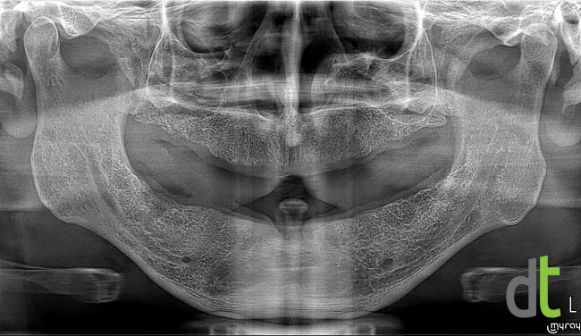 Panoramic radiograph before treatment, with no teeth remaining