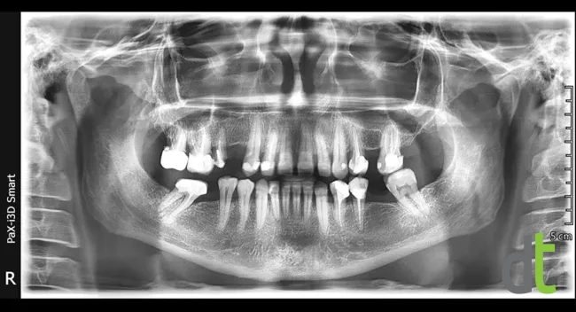 Panoramic radiograph before the complex implant treatment