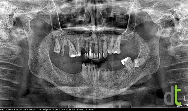 Panoramic radiograph before restoration of both jaws