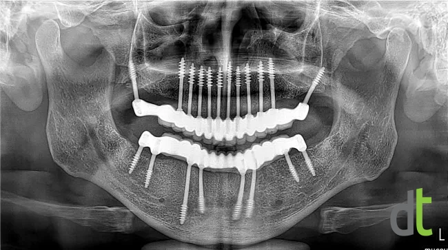 Panoramic radiograph after restoration of both jaws with basal implants and fixed restorations