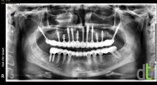 Panoramic radiograph after placement of implants and fixed restorations