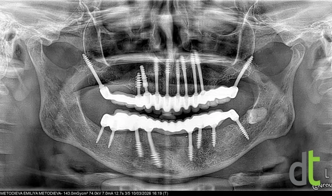 Panoramic radiograph after placement of basal implants and fixed restorations in both jaws