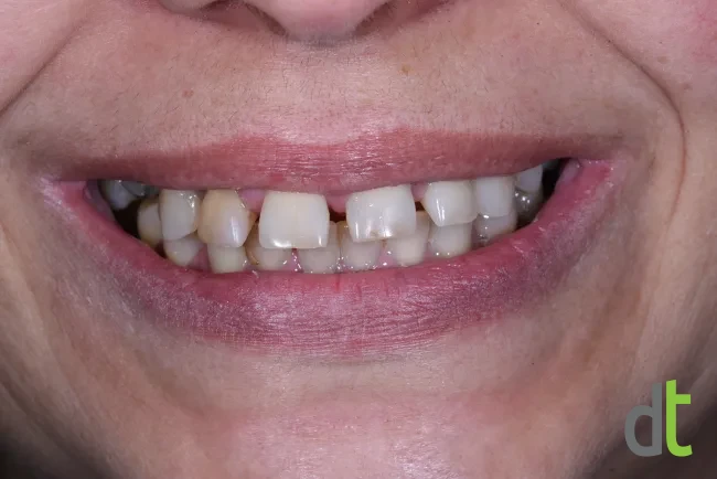 Smile before the complex restoration