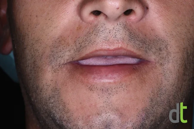 Smile before treatment, with no teeth remaining and the use of dentures