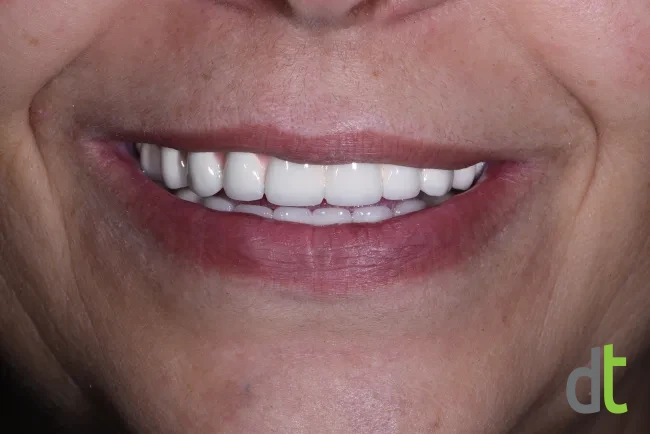 Smile after the complex restoration with fixed restorations