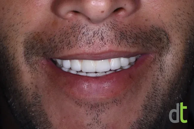 Smile after full restoration with fixed metal-ceramic restorations