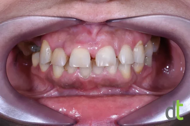 Initial condition with missing teeth, bone loss and periodontal changes
