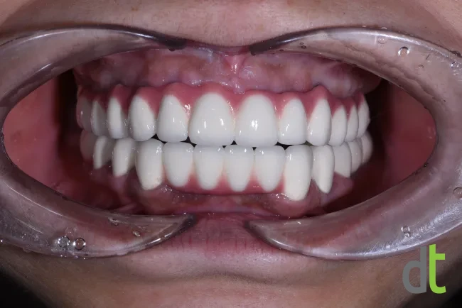 Fixed restorations in the upper and lower jaw after the complex treatment
